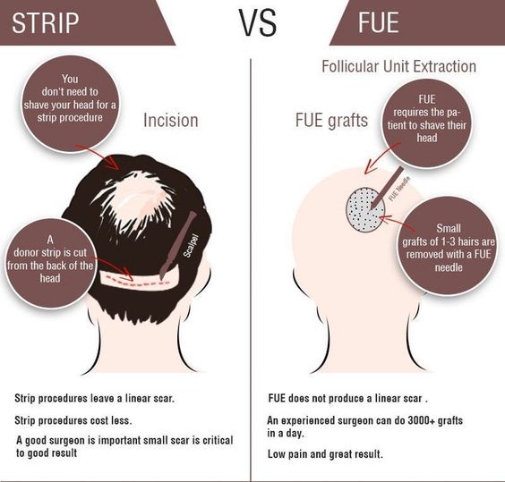 Strip vs Fue hair replacement therapy
