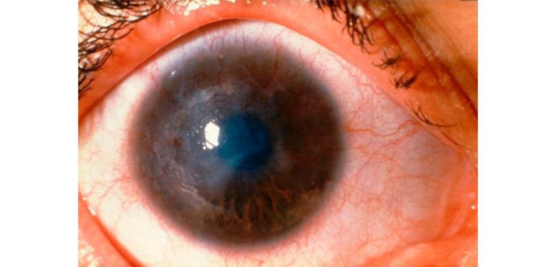 Trachoma WHO grade: corneal opacity (CO)' . Image Credit: Wellcome Collection. CC0