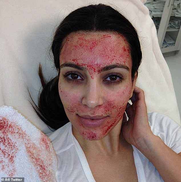 The P-shot, which is a variation on the so-called Vampire Facial, which Kim Kardashian posted a now infamous snap of herself undergoing in 2013 