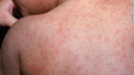 New York tackles &#39;largest measles outbreak&#39; in state&#39;s recent history as cases spike globally