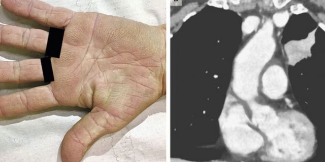 The woman's palms had a "velvety" appearance due to a rare condition.